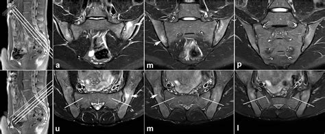 Sacroiliac Joint Mri