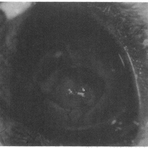 Candida Keratitis Of Group 3a 0u Debridement On Day 21 Download Scientific Diagram