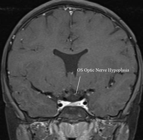 Unilateral Optic Nerve Hypoplasia in a patient desiring surgical treatment for his exotropia