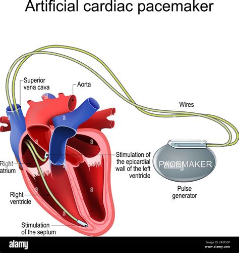 Artificial Cardiac Pacemaker Heart Implant Treatment Of A Bradycardia