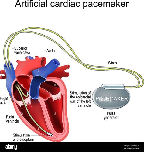 Künstlicher Herzschrittmacher Herzimplantat Behandlung einer