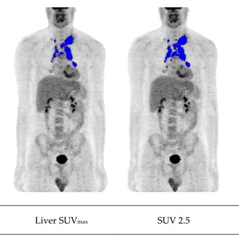 Metabolic Tumor Volume Mtv Measurement In A Patient With