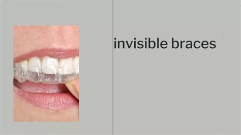 Ppt Invisible Braces Powerpoint Presentation Free Download Id 11562399