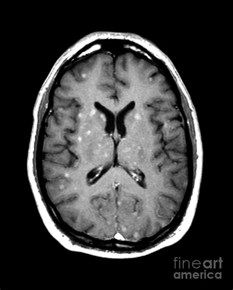 Abnormal Mri Of Brain Photograph by Medical Body Scans