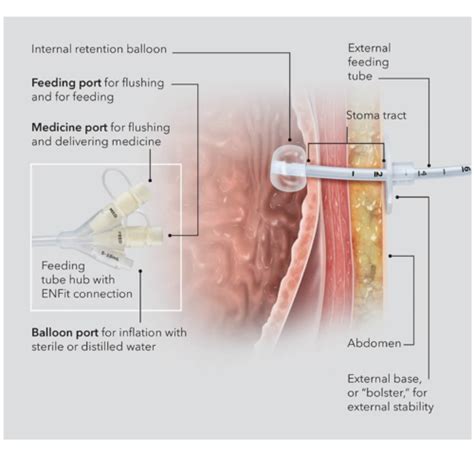 Enteral And Parenteral Nutrition Flashcards Quizlet