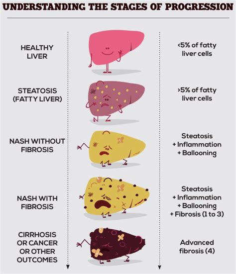Stage 4 Liver Cancer Symptoms Artofit