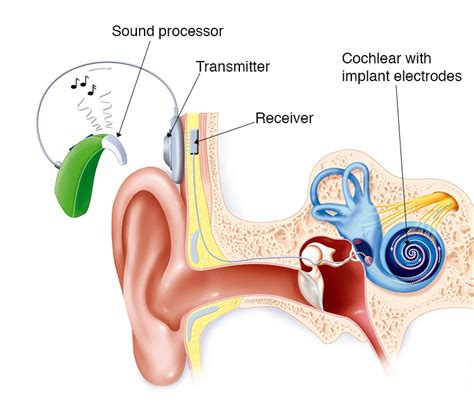 Cochlear Implant - Procedure, Surgery and Benefits