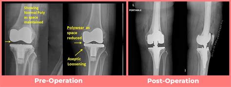 Revision Knee Replacement Surgery Delhi Institute Of Trauma