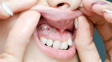 Oral Cysts Do Udent Dental Clinic