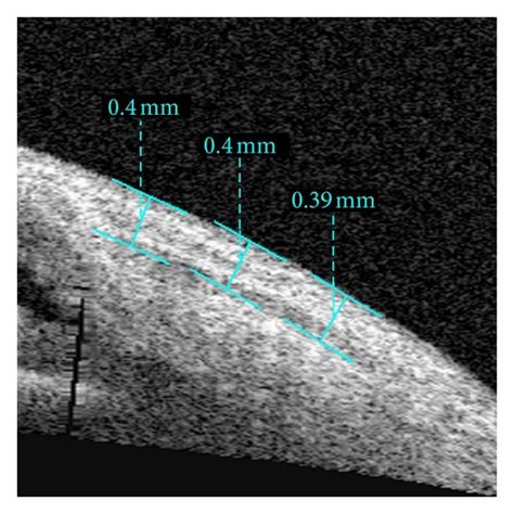 Imaging Of As Oct Shows Measurement Of Thickness Of The Conjunctival Download Scientific