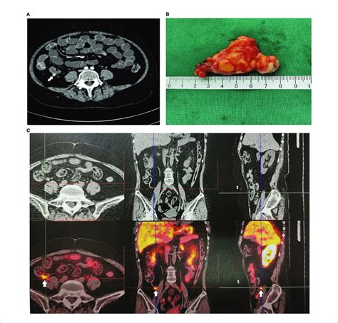 | Imaging examination of appendiceal mass. (A) Appendiceal mass showed ...