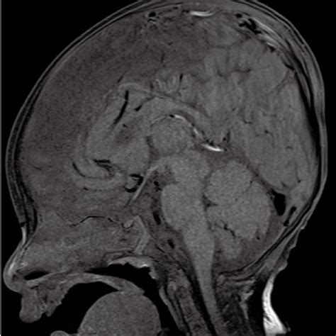 T Weighted Sagittal Magnetic Resonance Image Of The Brain Showing