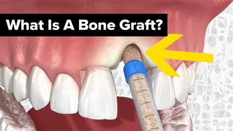 Medical Cpt Code For Dental Bone Graft At Kenneth Thomas Blog