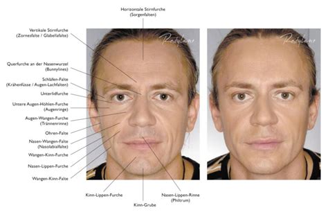 Hyaluron Behandlung Beim Mann Sthetik First Men