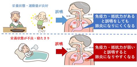 誤嚥性肺炎の予防とは 八尾市 にじリハ訪問看護ステーション