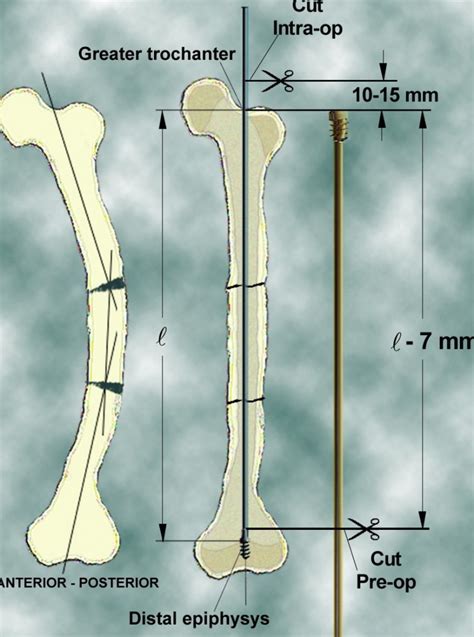 Hastes Telescopadas Na Osteog Nese Imperfeita Osteogenesis Imperfecta