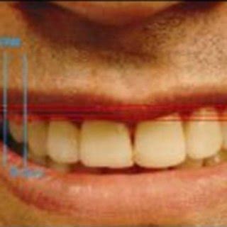 Buccal corridor/lateral negative space [20] | Download Scientific Diagram