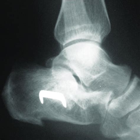 At final follow-up X-ray: restitution of the Böhler angle, measured at 20° | Download Scientific ...