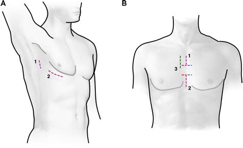 Minimally Invasive Surgery For Congenital Heart Disease The Annals Of