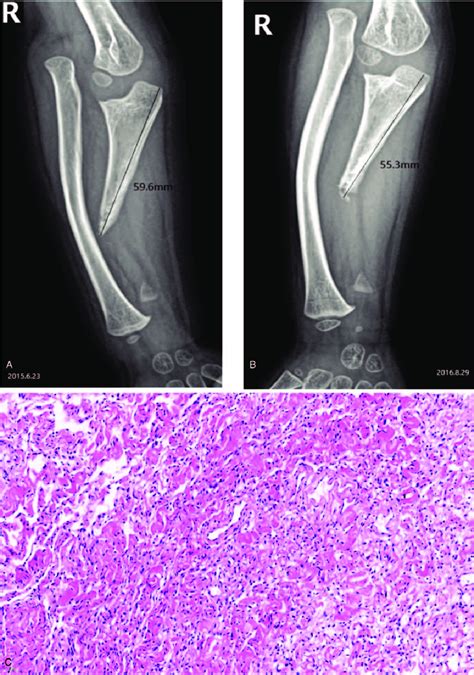 A X Ray Imaging Shows A Right Ulna Distal Defect Distal Epiphyseal