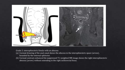 Radiological Imaging In Perianal Fistula Ppt