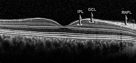 Measurement Of The Gcl And Ipl Thicknesses With Spectral Oct Gcl