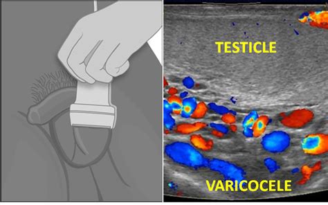 Scrotal Sonography Sunflower Hospital