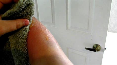 Gross Oozing Sunburn Blisters Youtube