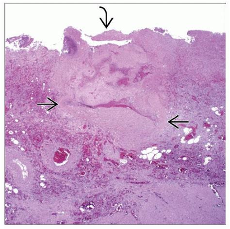 Dieulafoy Lesion Basicmedical Key