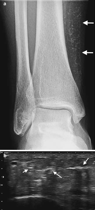 Soft Tissue Calcifications | Radiology Key