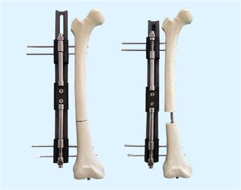 Pediatric Lrs System Orthofix Limb Lengthening External Fixator