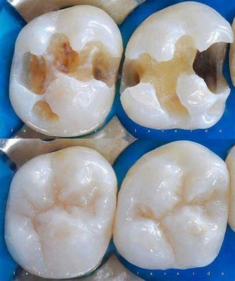 Pin by Amy Izquierdo on Odontología Dental Dental fillings Happy dental