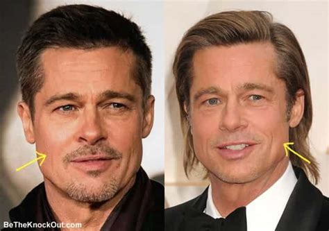 Brad Pitt Plastic Surgery Comparison Photos