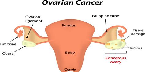 Ovarian Cancer Symptoms: 10 Early Warning Signs You Need to Know