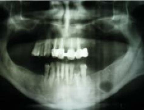 Radicular Cyst In The Orthopantomogram Destruction In The Center Of The