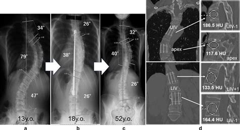 A Radiograph Of A 13 Year Old Girl With Lenke Type 2 Adolescent Download Scientific Diagram