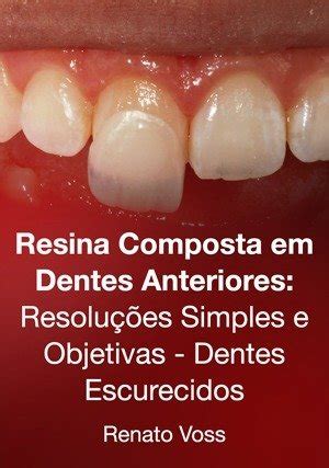 Assista online Resina Composta em Dentes Anteriores Resoluções