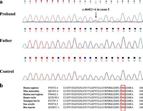 Mutation Analysis Of The Patient With Pagets Disease Of Bone A Sanger