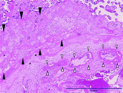 The Microscopic Findings Of The Placenta Hematoxylin And Eosin Stain