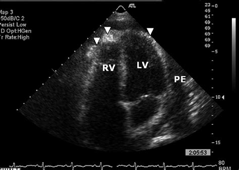 Echocardiography Demonstrated The Pericardial Effusion 2 Cm In Diameter