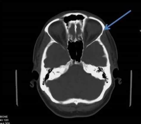 Greater Wing Sphenoid - CT Tutor