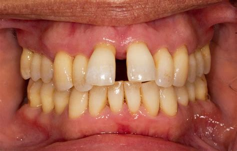 Gum Disease Treatment In London GRDC