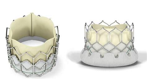 Fda Approves Edwards Sapien 3 Ultra Transcatheter Heart Valve Idata