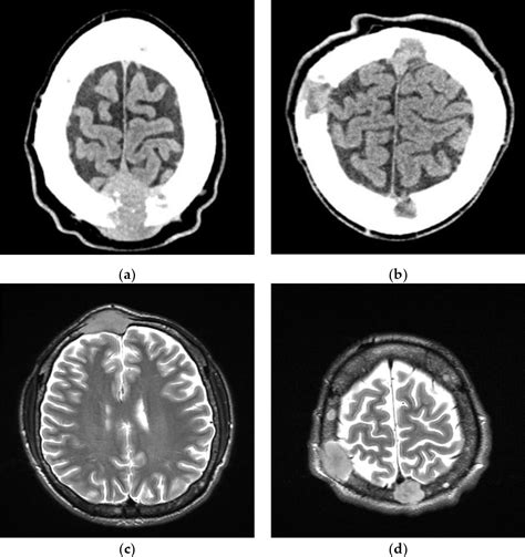 Figure 1 From Secondary Hemophagocytic Syndrome In A Patient With