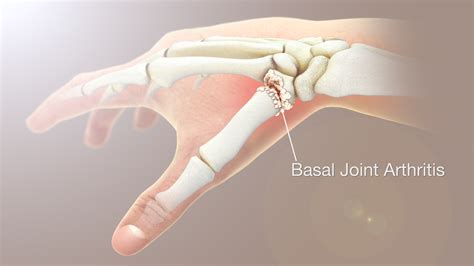 Basal Joint Arthritis – Symptoms, Causes, & Treatment