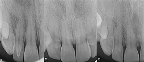 Examples of talon cusp types; a type I talon cusp in maxillary right ...