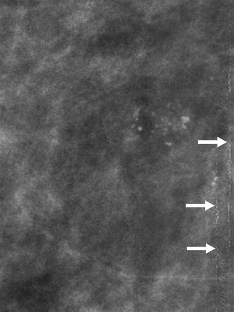 Optimizing Digital Mammographic Image Quality For Full Field Digital