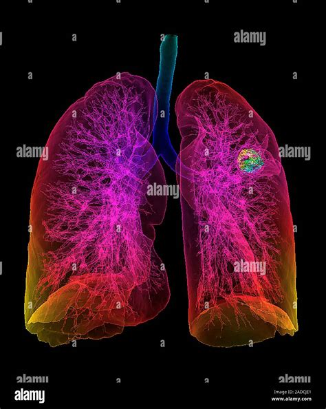 Lung Cancer Coloured 3d Frontal Computed Tomography Ct Scan Of Human