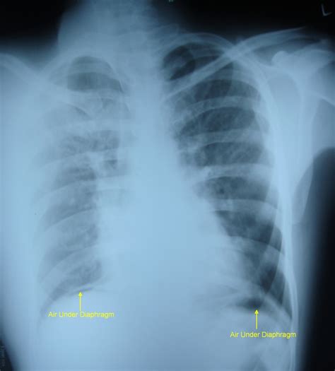 Air Under Diaphragm X Ray