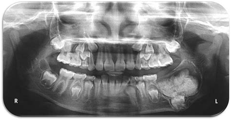 Ameloblastic Fibro Odontoma BMJ Case Reports